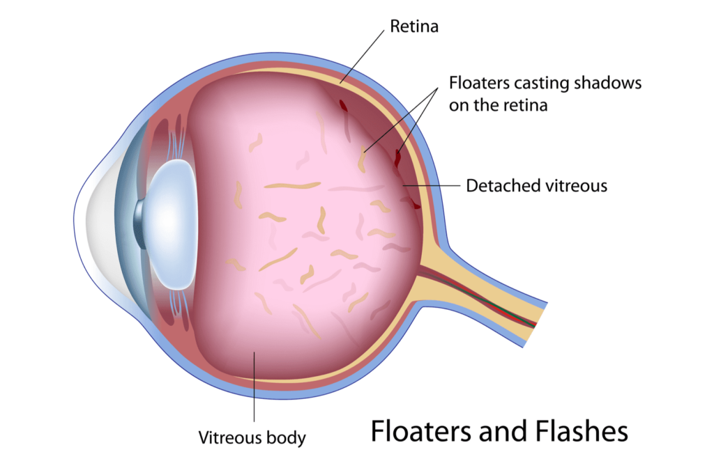 A diagram of the eye highlight the vitreous body and retina to show how floaters cast shadows on the retina
