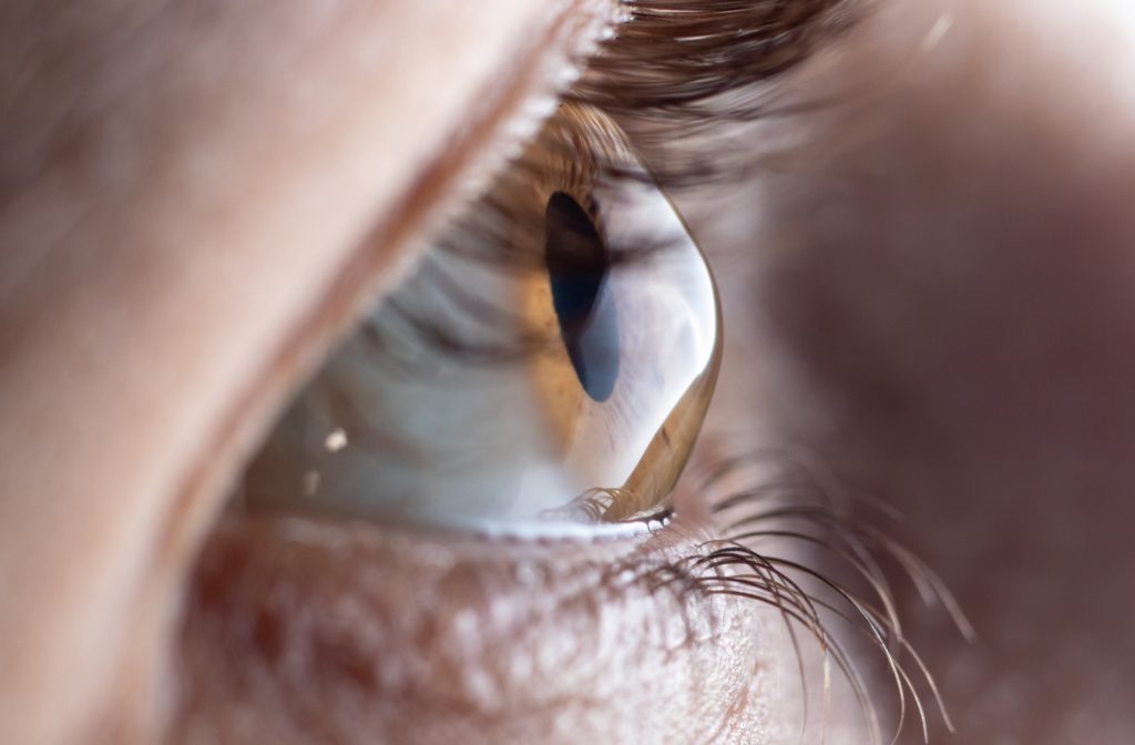 A close up of someone's eye that suffers from a cone-shaped cornea, also known as keratoconus