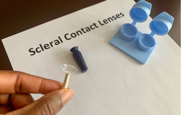 A person holding scleral contact lenses on a tool used to put them on the eye