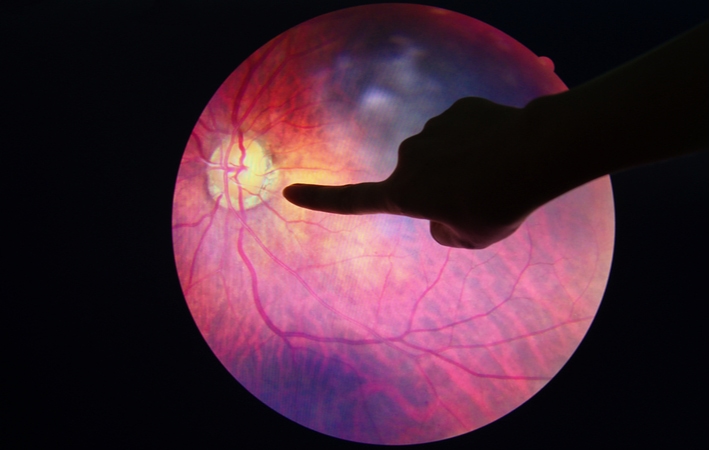 An optometrist pointing to a damaged blood vessel on an enlarged image of a patient's eyeball