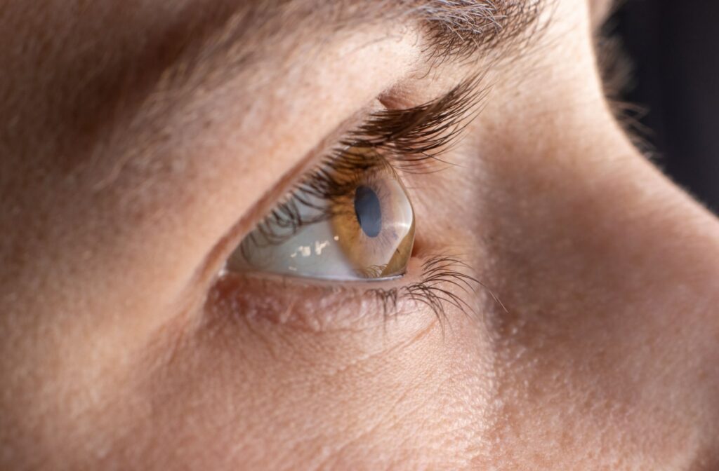 A close up view of a woman's eye with keratoconus present